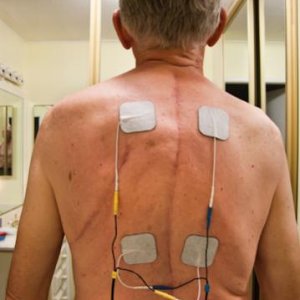 This is the scar from my 15 vertebrae fusion (T2 to L4) and muscle stimulator electrodes in place. The scar on the left side under my shoulder was whe