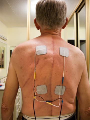 This is the scar from my 15 vertebrae fusion (T2 to L4) and muscle stimulator electrodes in place. The scar on the left side under my shoulder was whe